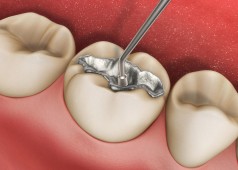Dental-Filling-e1419365996306