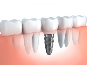 implants02-300x225